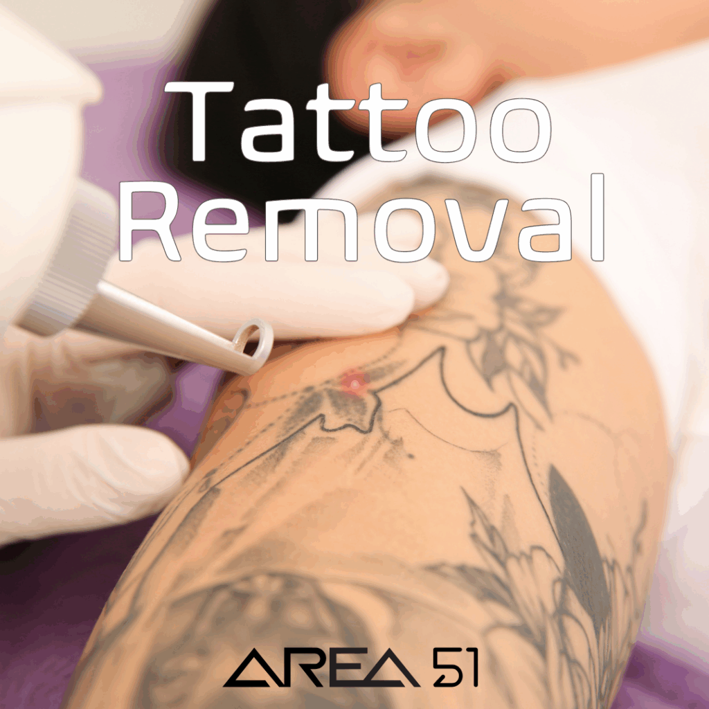 Tattoo removal sessions, how many will it take?